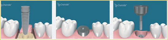 قراردهی ایمپلنت دندانی