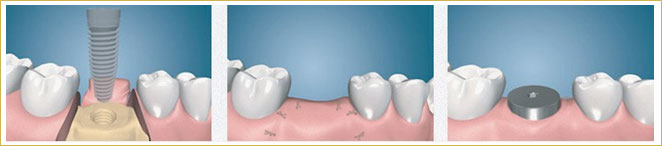 قراردهی دو مرحله ای ایمپلنت دندانی