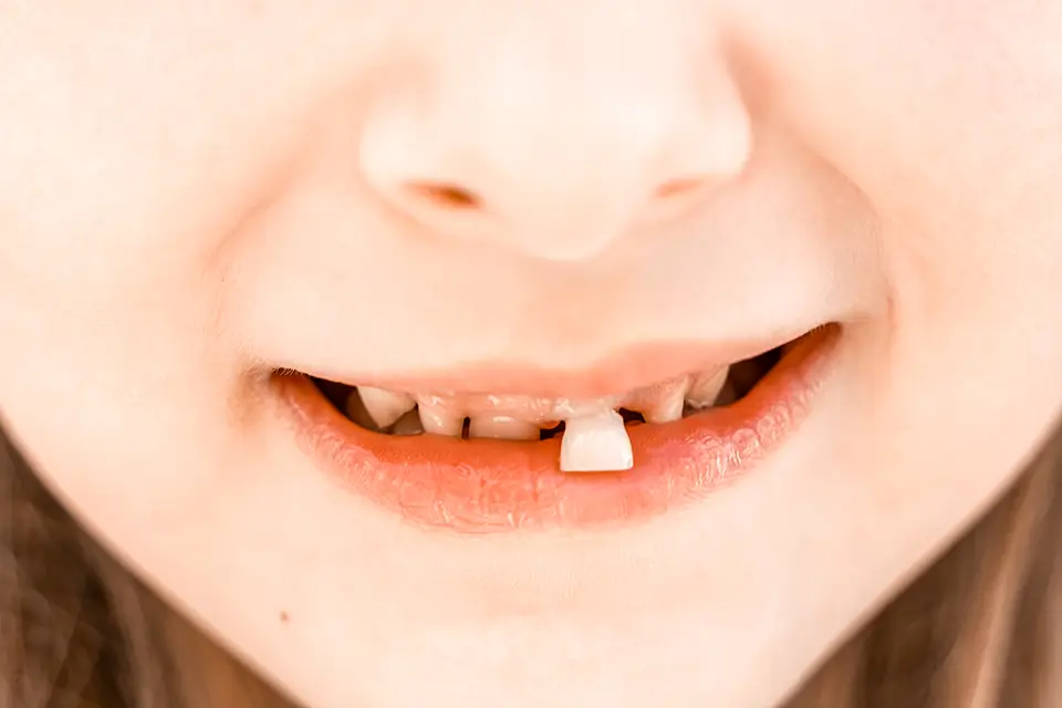 How To Handle A Loose Tooth 5 How To Handle A Loose Tooth