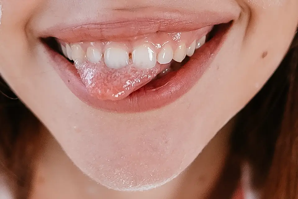 What Is a "Gummy Smile?" 11 What Is a "Gummy Smile?"