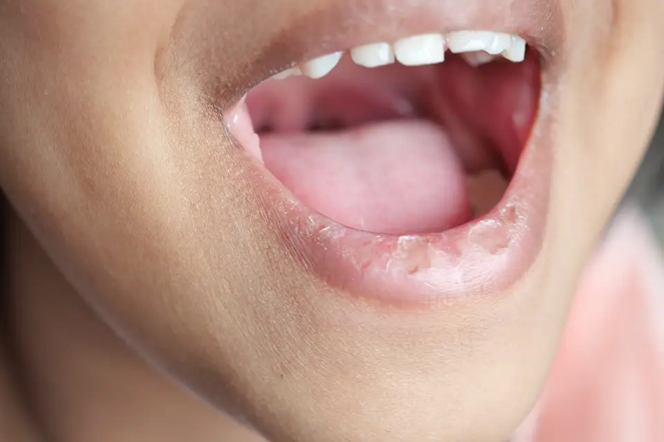 Dry Mouth & How to Treat It 1 Why Does Dry Mouth Happen?