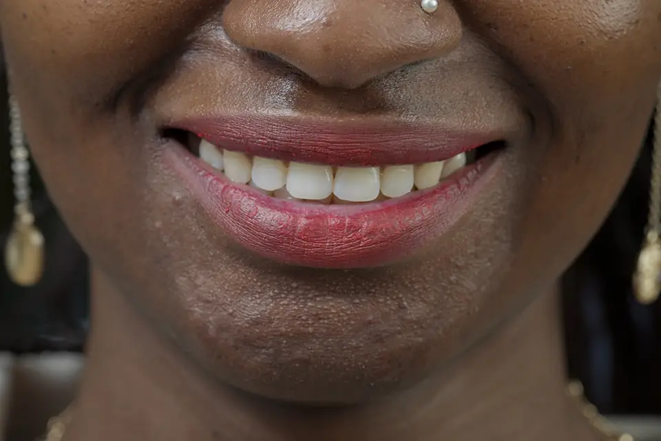 What Is a "Gummy Smile?"