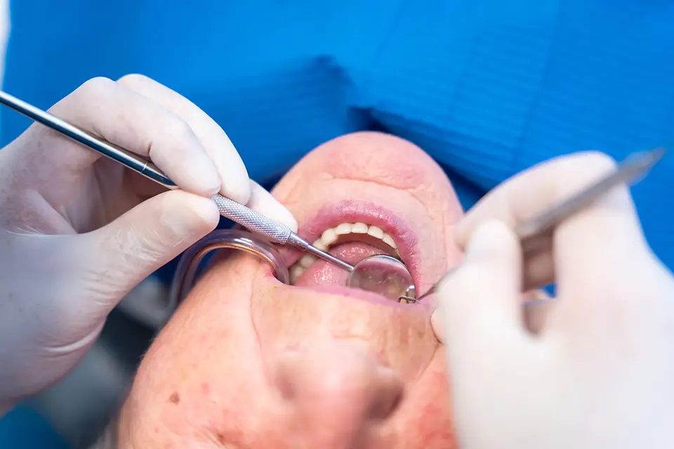 Which is Better – Root Canal or Extraction? 1 When Should You Consider Tooth Extraction?