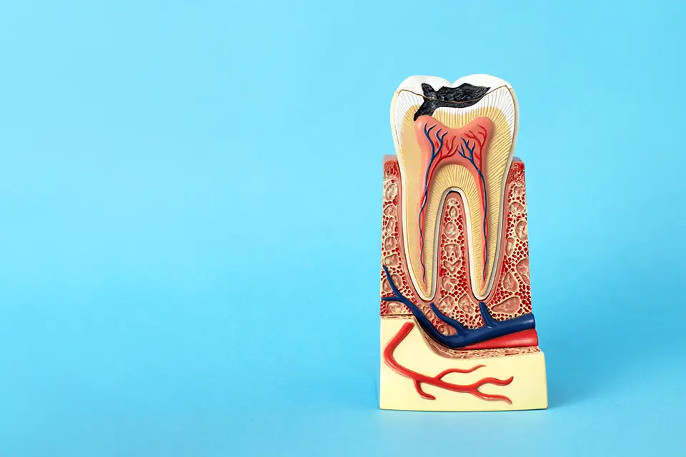 Tips To Avoid a Root Canal 10 Tips To Avoid a Root Canal