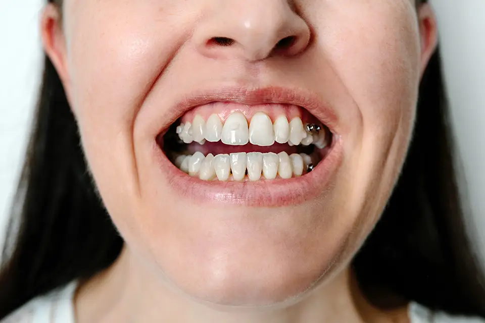 What Causes an Underbite and How Can I Treat It? 15 What Causes an Underbite and How Can I Treat It?