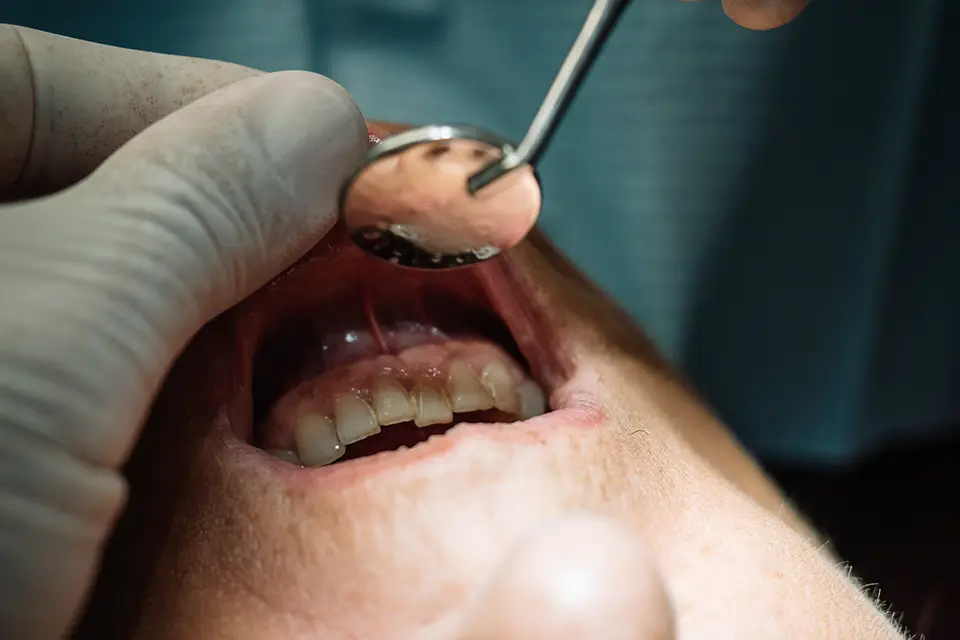 Which Surgical Procedures Treat Oral Cancer? 1 Surgical Procedures that Treat Oral Cancer
