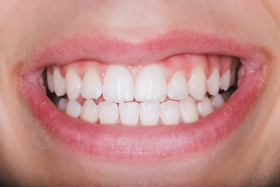 Gum Recession Symptoms