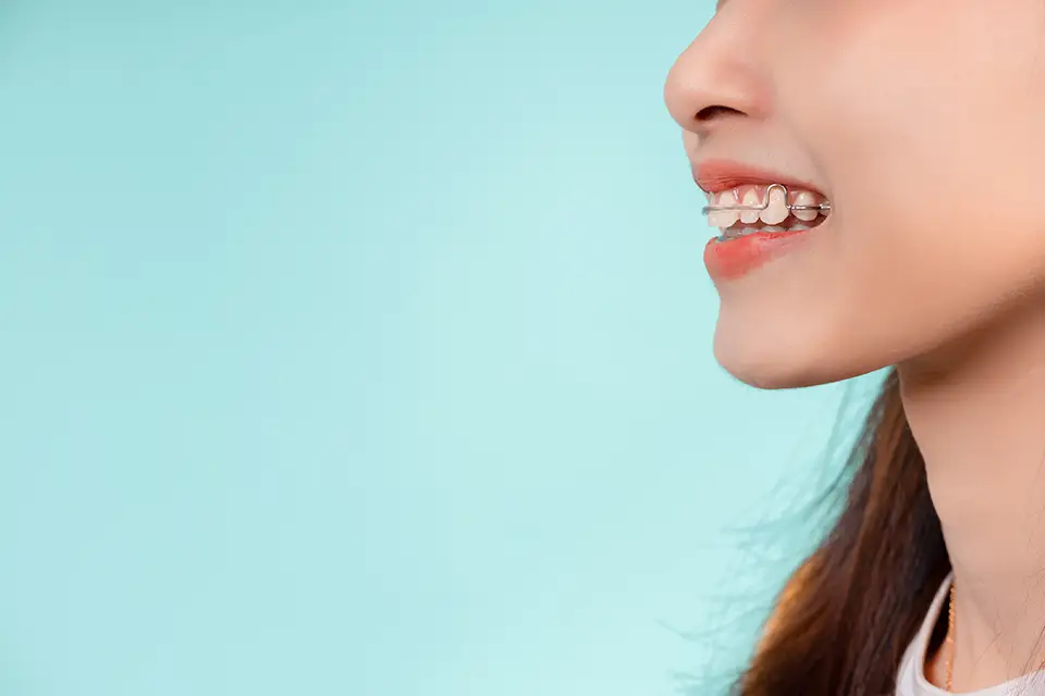 Overbite - ORIS Dental Clinics - Richmond Hill - (647) 367 6747