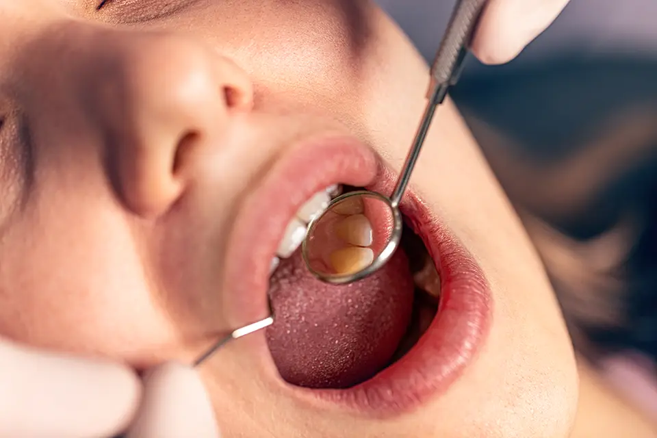 What Is an Oral Cyst? 1 Symptoms of Oral Cyst