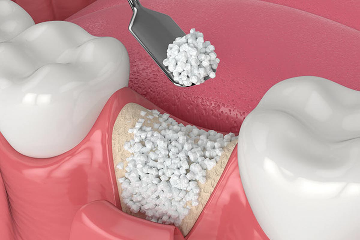 What Is A Dental Bone Graft