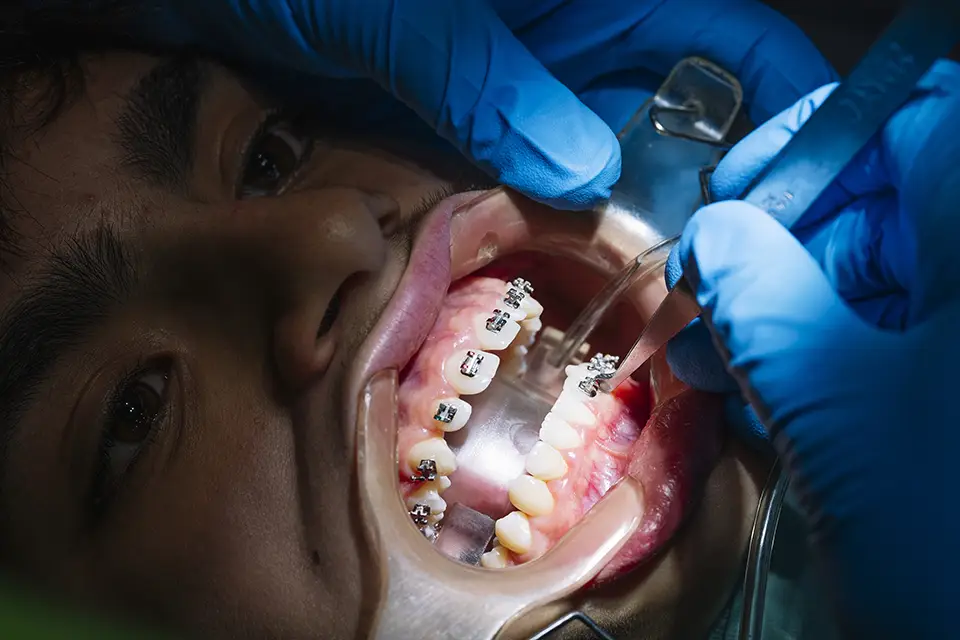 What Is an Early Orthodontic Treatment? 1 What Is an Early Orthodontic Treatment?