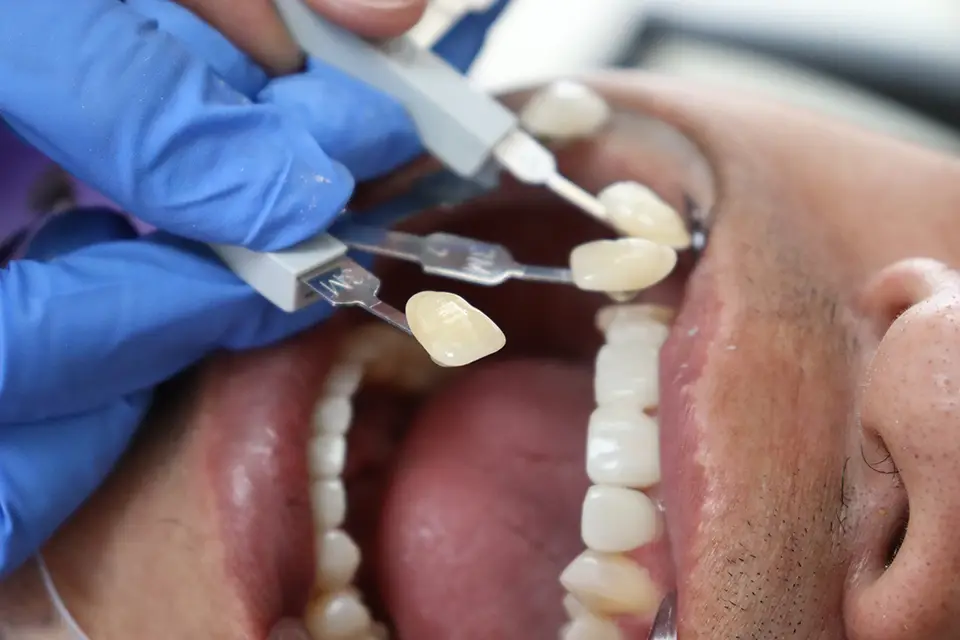Is a Root Canal Necessary Before a Dental Crown on a Cracked Tooth? 5 Is a Root Canal Necessary Before a Dental Crown on a Cracked Tooth?