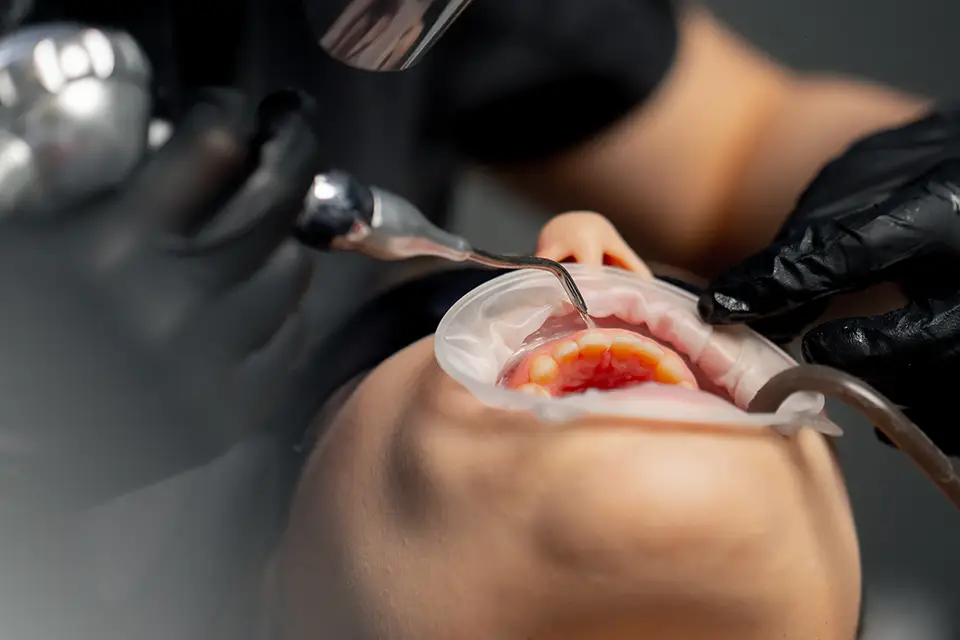 Restoring Healthy Smiles: The Journey of Getting a Soft Tissue Graft for Gum Recession 7 Restoring Healthy Smiles: The Journey of Getting a Soft Tissue Graft for Gum Recession