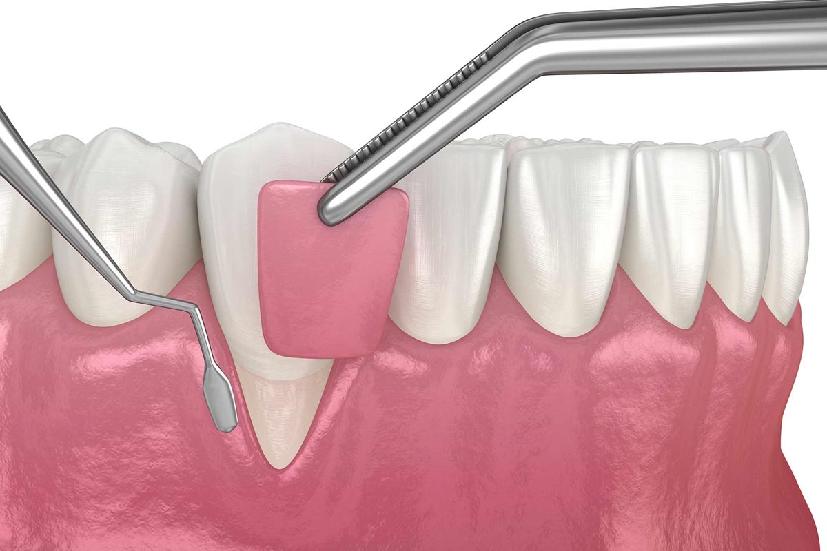 Understanding Gum Grafting Procedures at ORIS Dental Clinics in Richmond Hill, Ontario