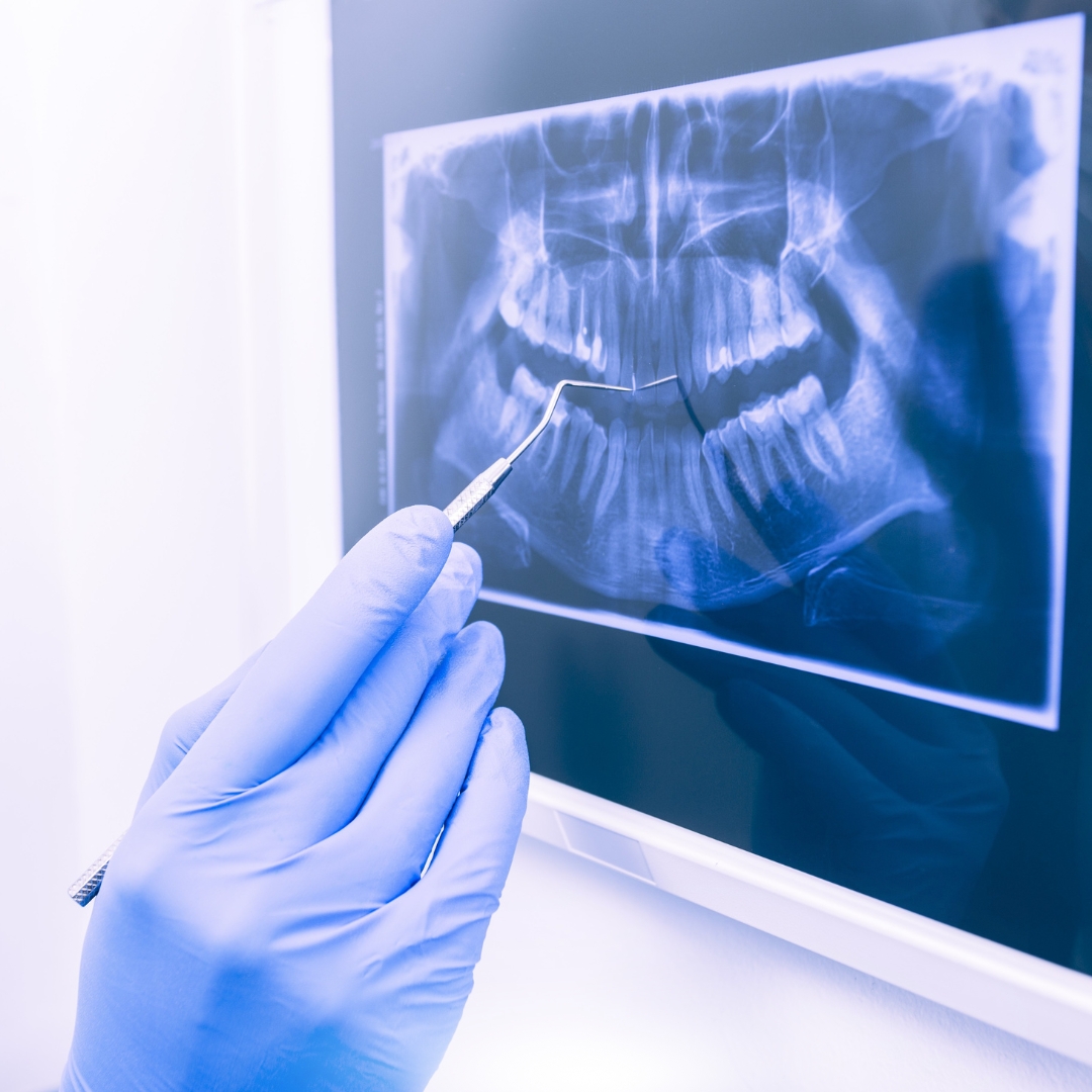 Types of Dental Crowns