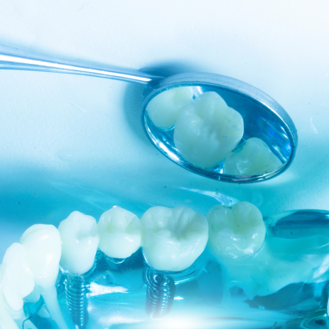 Dental Implants and Sinus Lifts Addressing Bone Volume Issues at ORIS Dental Clinics