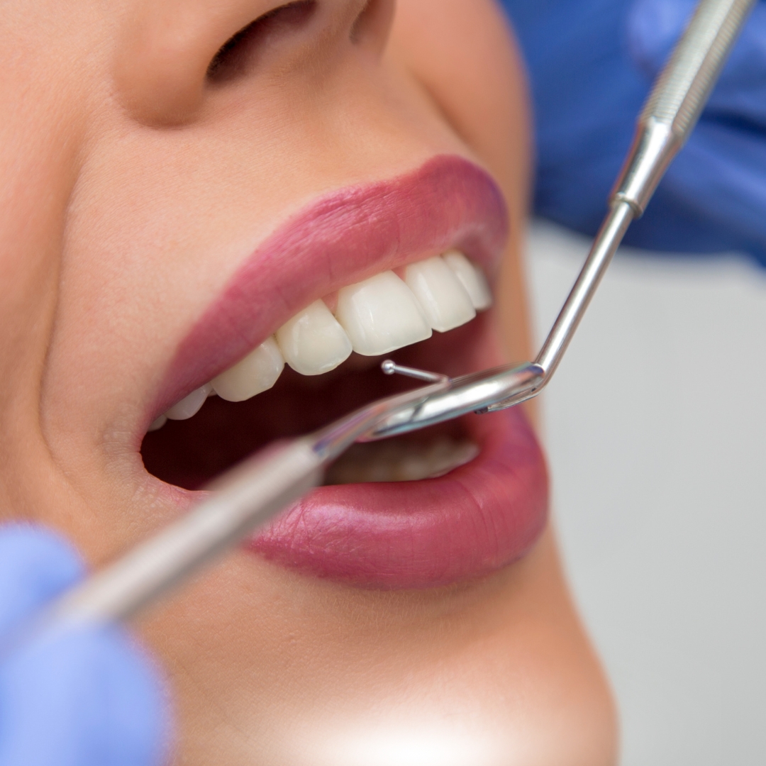 Dental Bonding: Post-Treatment Dietary Considerations