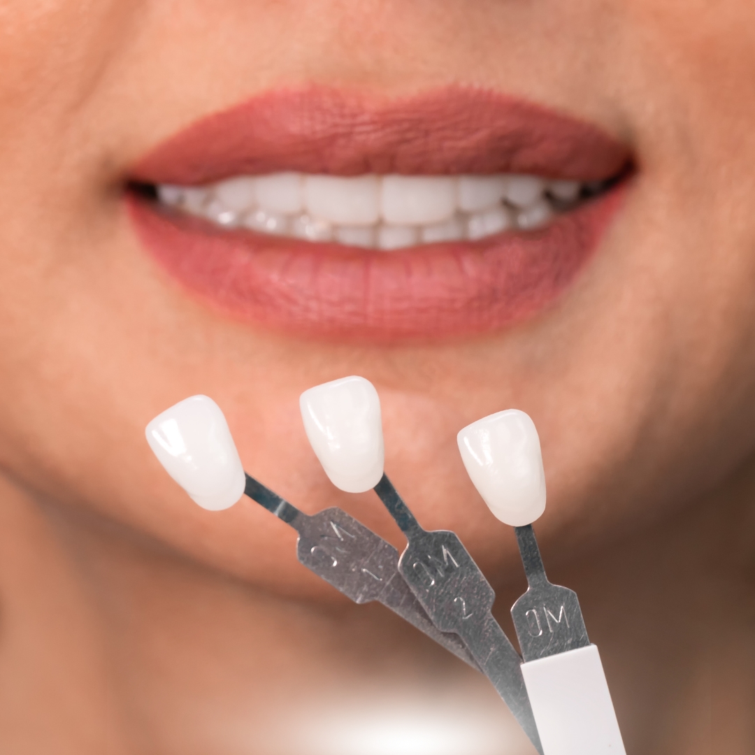 Dental Crowns vs. Veneers