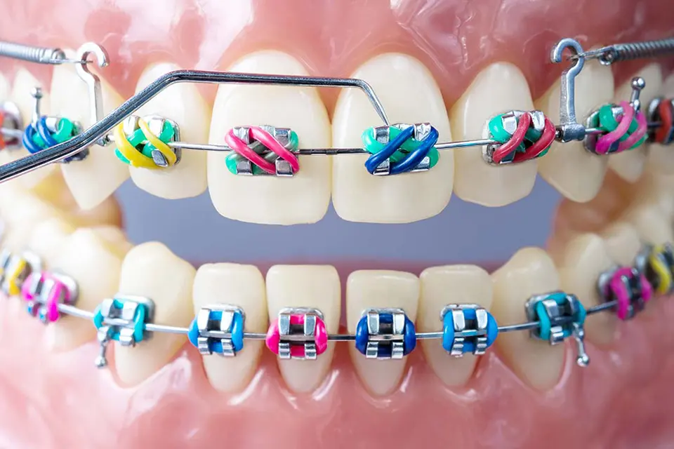 Orthodontic Treatment Duration -ORIS Dental-Ontario-6473676747