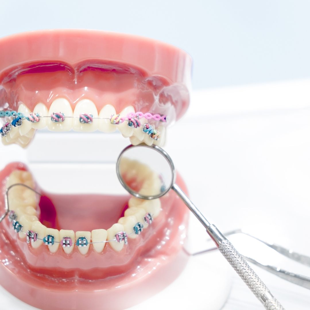 Understanding Orthodontic Treatment Duration at ORIS Dental Clinics