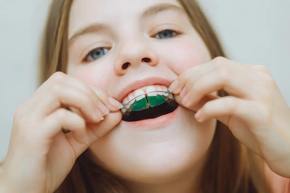 Unlocking the Smile Makeover Journey: Understanding Orthodontic Treatment Duration at ORIS Dental Clinics 7 Unlocking the Smile Makeover Journey: Understanding Orthodontic Treatment Duration at ORIS Dental Clinics