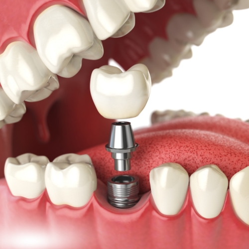 Navigating the Cost of 2 Dental Implants with Bone Grafting