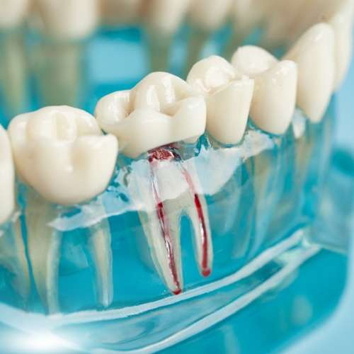 Low-Cost Root Canal Near Me: Affordable Dental Care