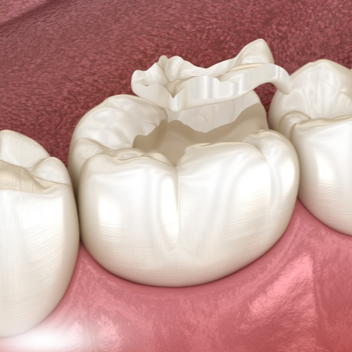 Cracked Tooth Under Crown with Root Canal: A Comprehensive Guide