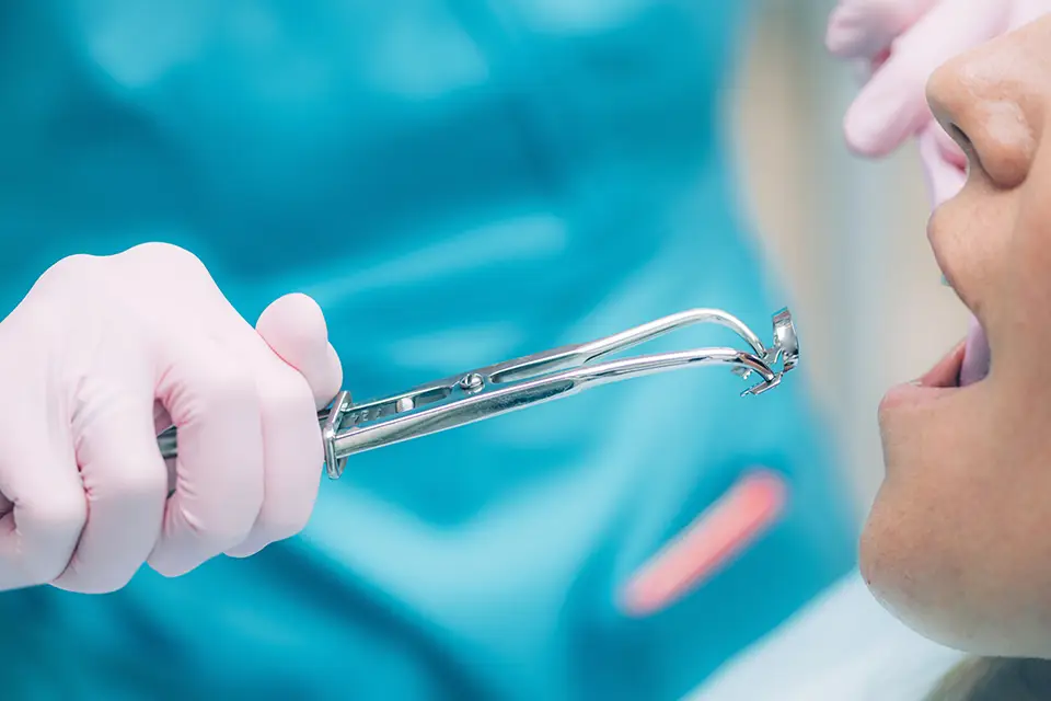Low-Cost Root Canal Near Me: Affordable Dental Care 3 Low-Cost Root Canal Near Me: Affordable Dental Care