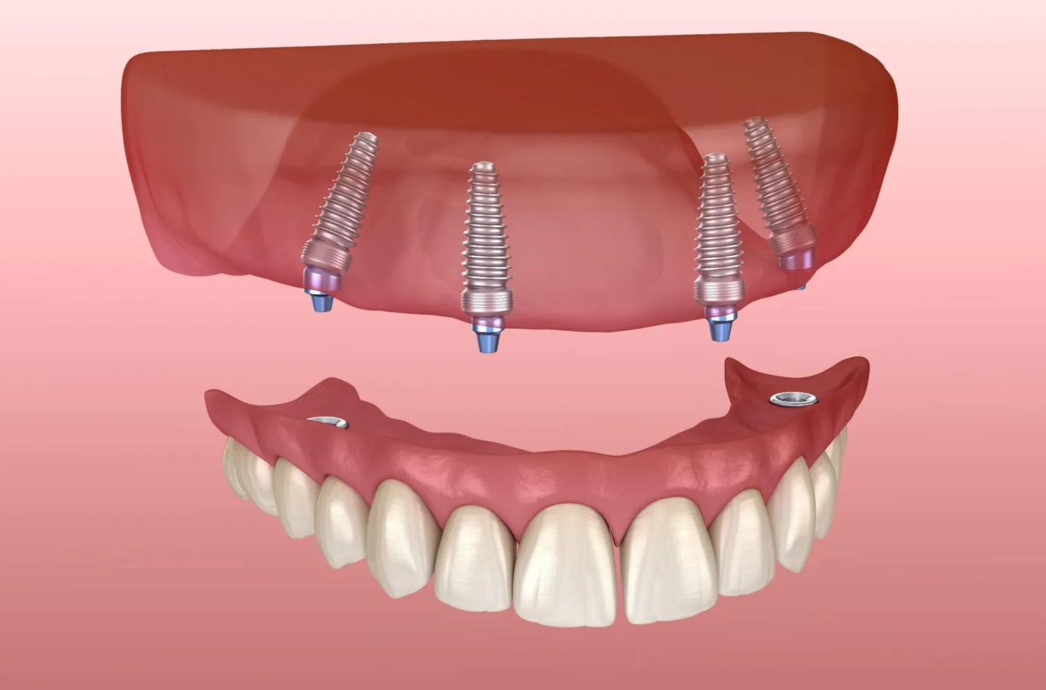 Denture Implants