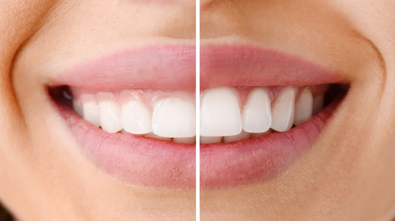 LANAP Laser Gum Surgery Near Me