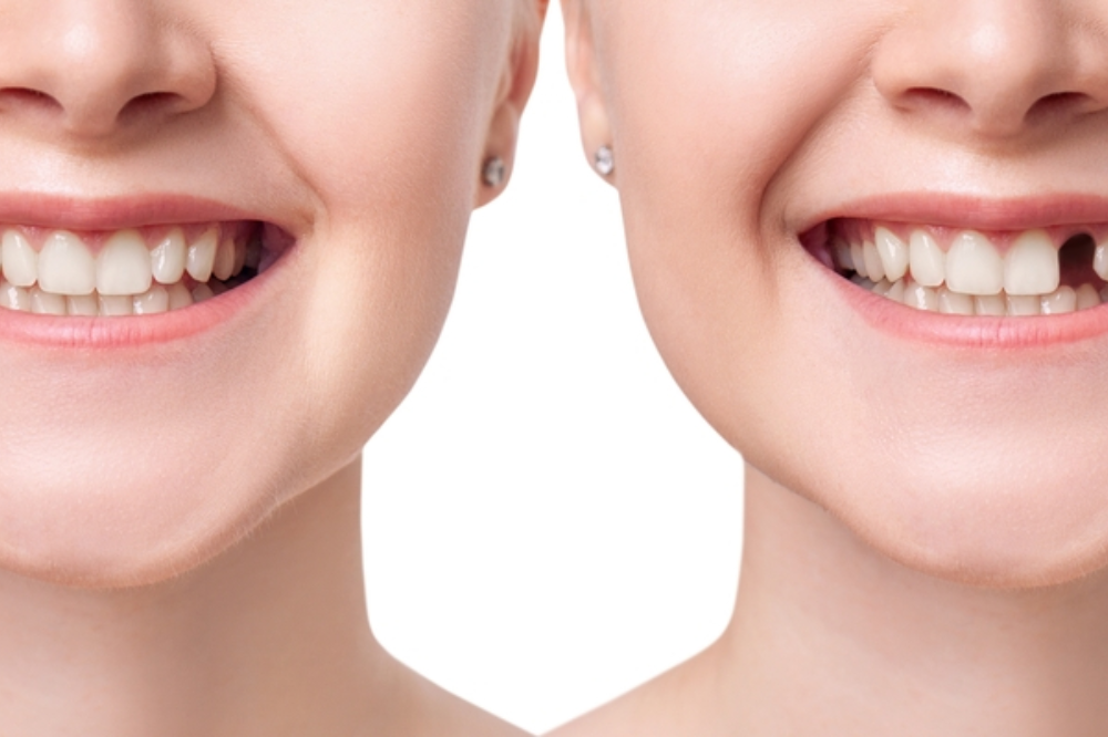The Best Options for Tooth Replacement