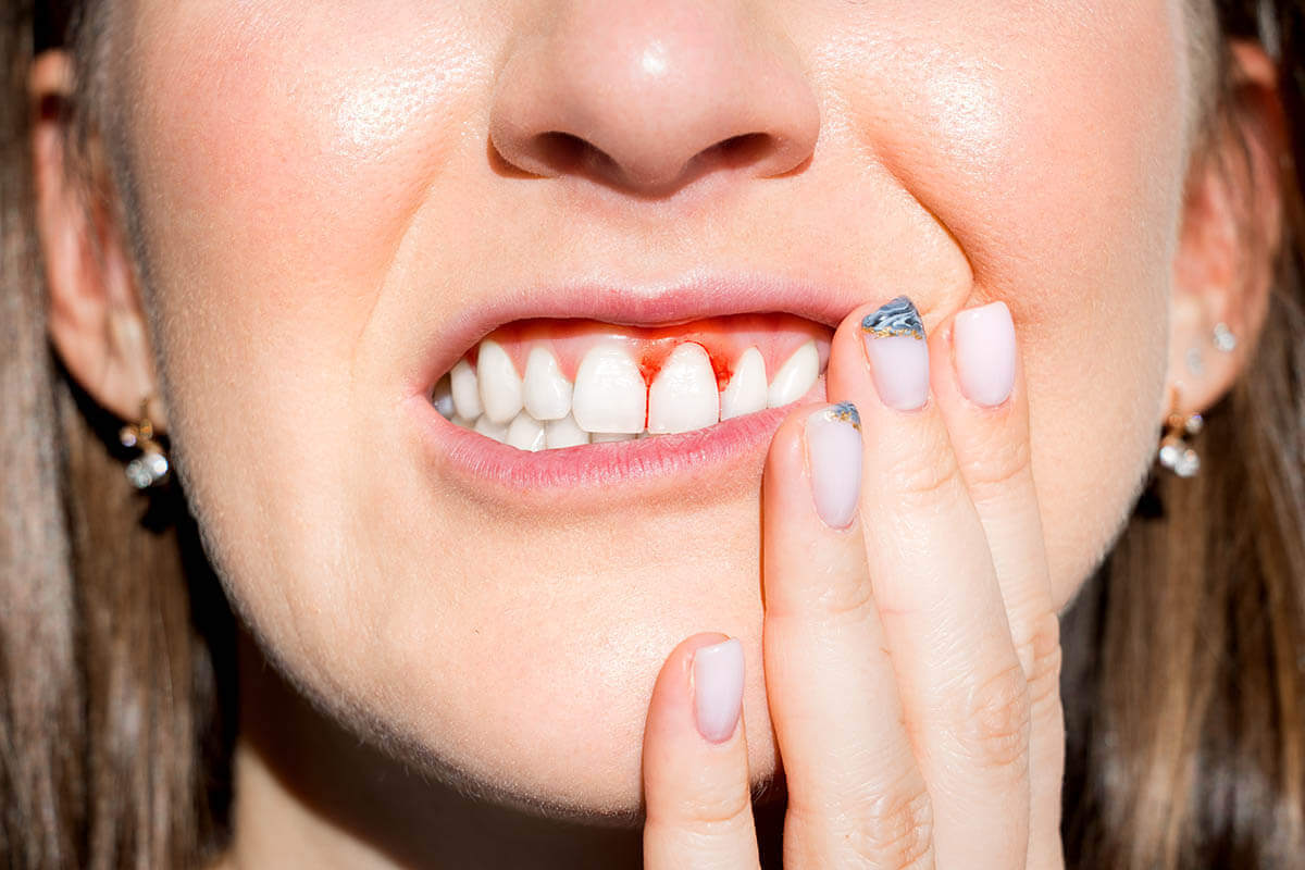 Periodontal Disease