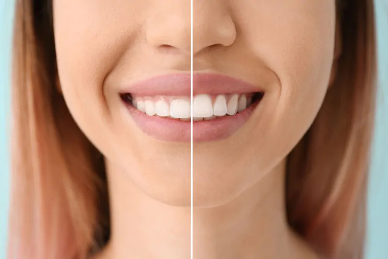 Periodontal Surgeries