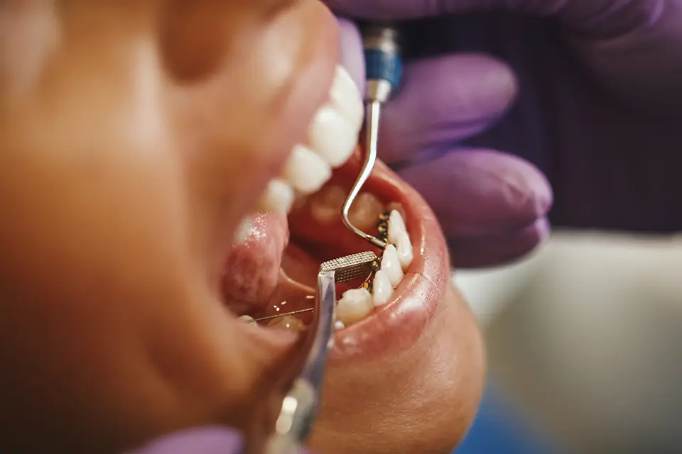 Periodontal Disease 12 Periodontal Disease