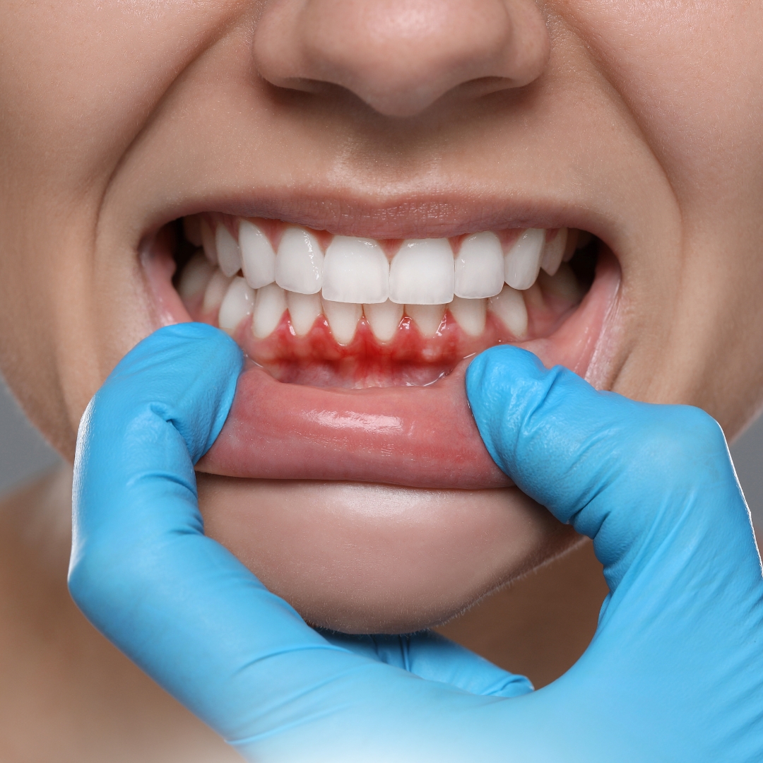 Gum Therapy in Toronto | Expert Periodontal Care at Oris Dental