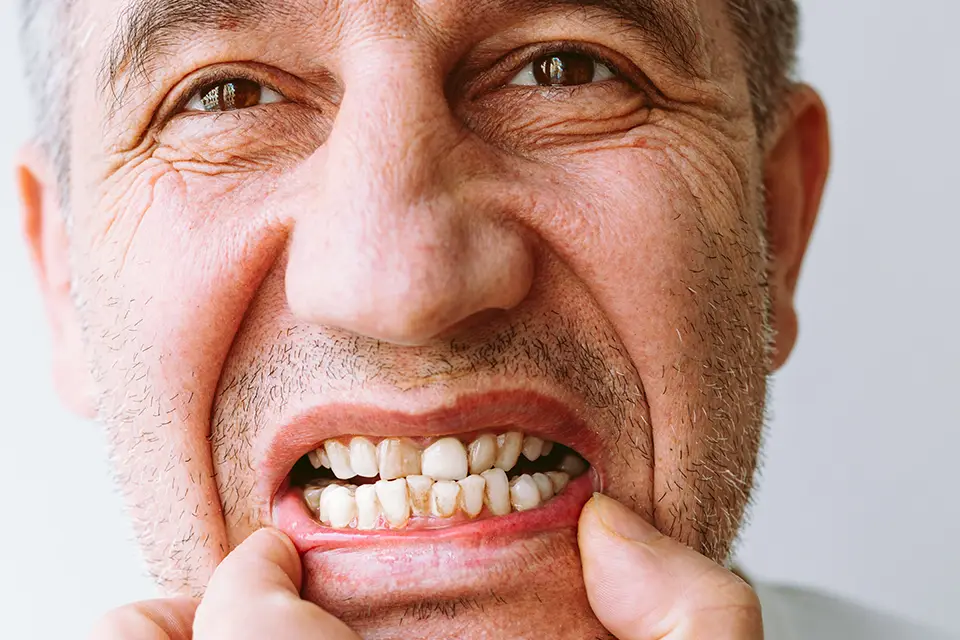 How Long Can Periodontal Disease Affect Teeth? | Oris Dental Insights 7 How Long Can Periodontal Disease Affect Teeth? | Oris Dental Insights