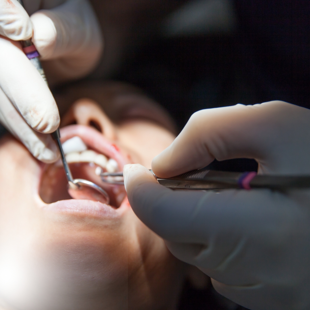 Comprehensive Guide to Periodontal Surgeries . Schedule your consultation with our skilled Periodontal Surgeries.