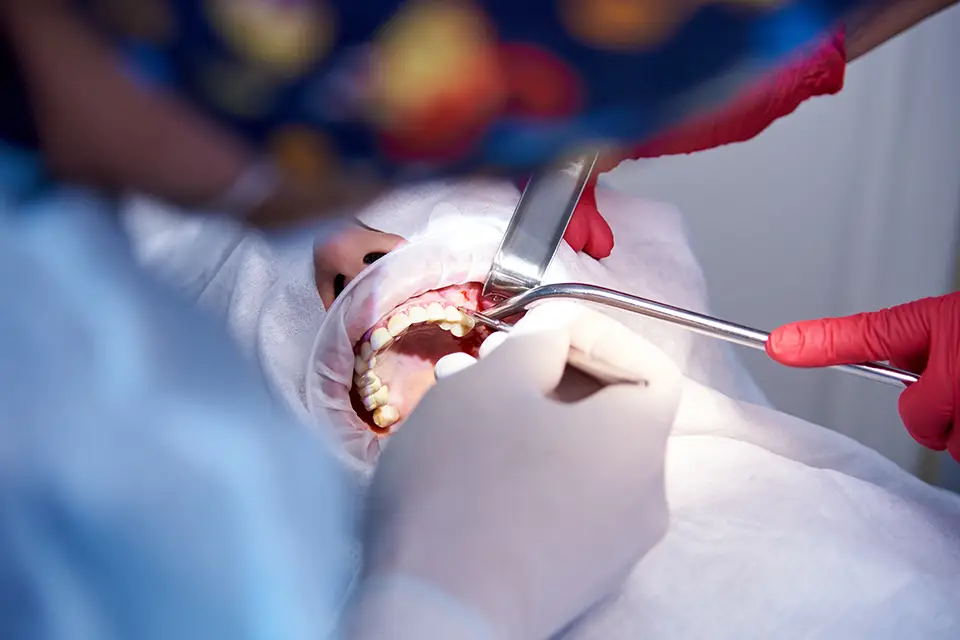 Minimally Invasive Wisdom Tooth Extraction in Richmond Hill