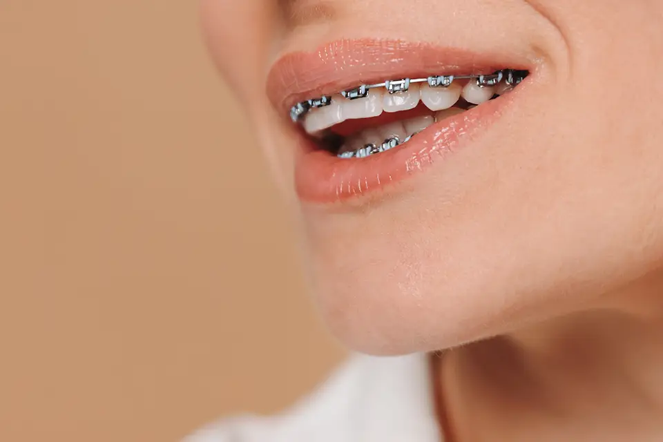 What Is Orthodontics? Everything You Need to Know 5 What Is Orthodontics? Everything You Need to Know