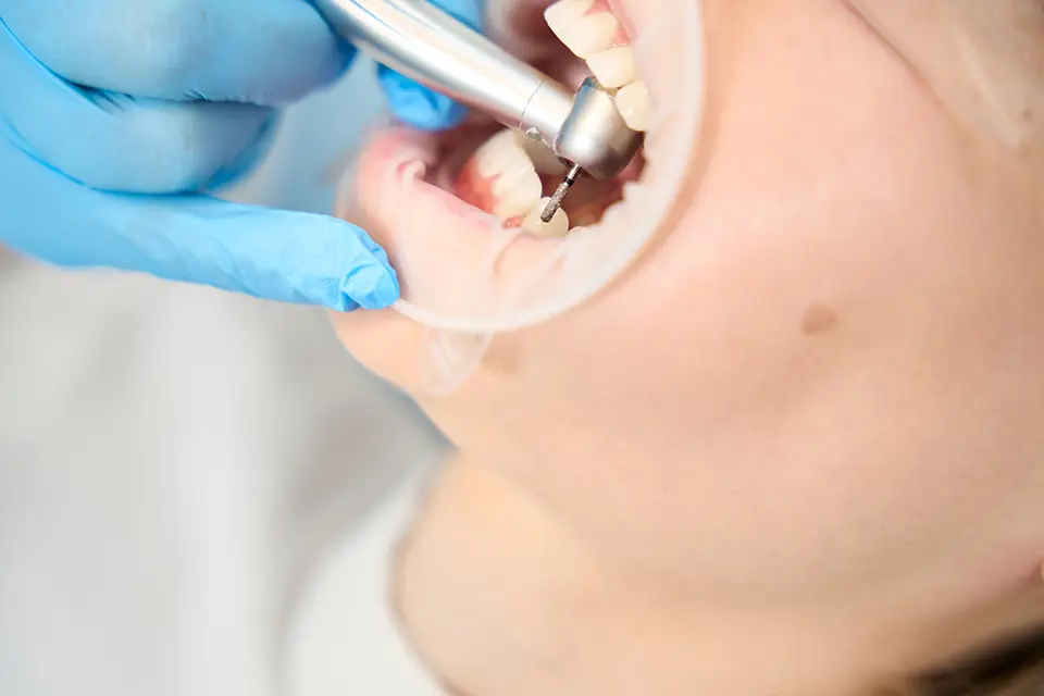 Types of Tooth Fillings: Which One Is Right for You? 1 Types of Tooth Fillings: Which One Is Right for You?