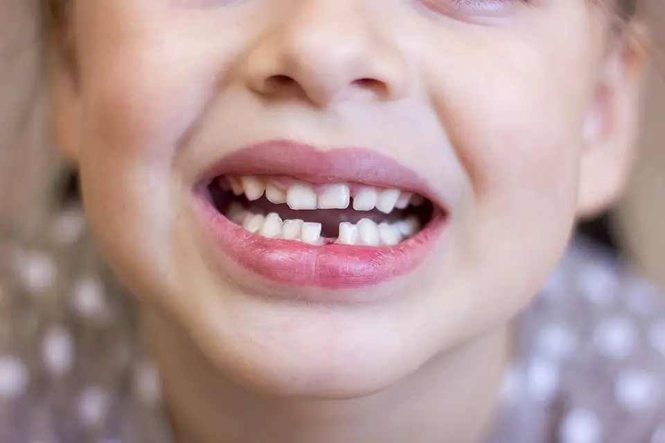 Stainless Steel Crowns for Kids: Safe and Effective Solutions