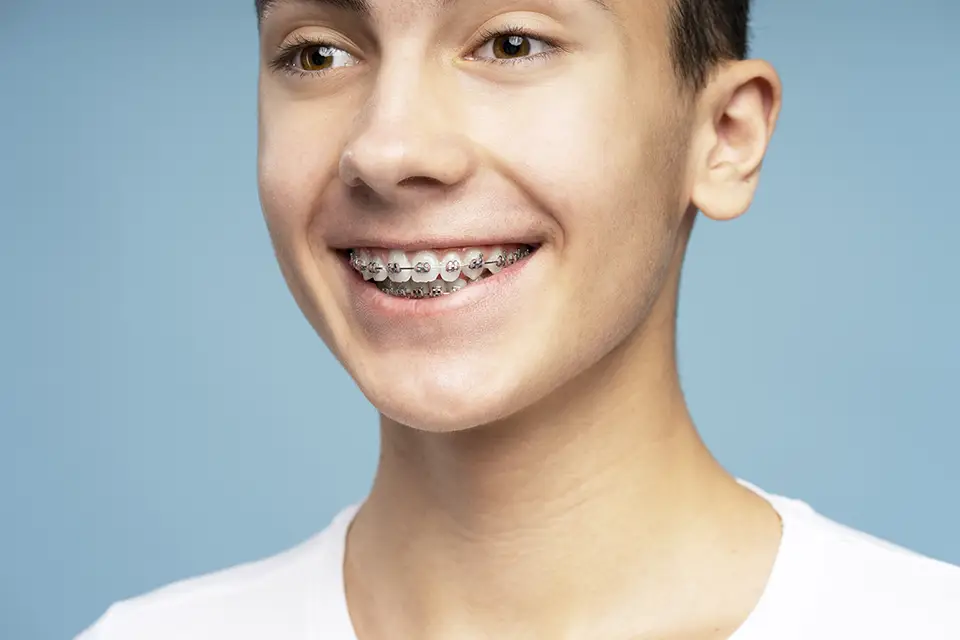 7 Types of Orthodontic Braces Explained 4 7 Types of Orthodontic Braces Explained