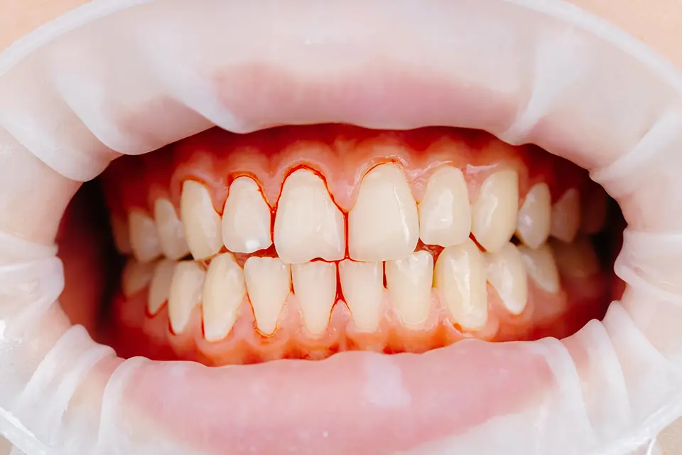 10 Early Signs of Gum Disease You Should Never Ignore 4 10 Early Signs of Gum Disease You Should Never Ignore