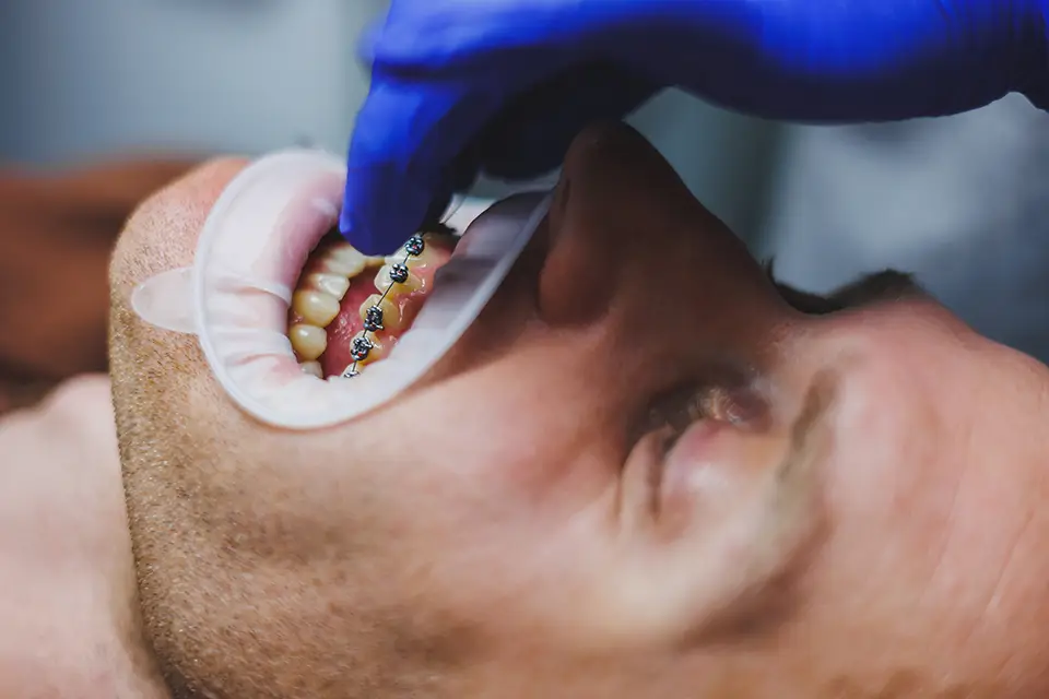 Invisalign vs Braces: How Each Method Actually Moves Teeth