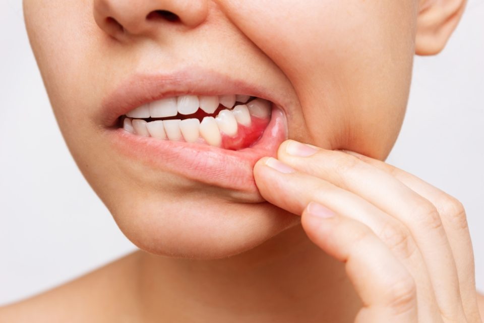 periodontal disease affecting teeth and gums