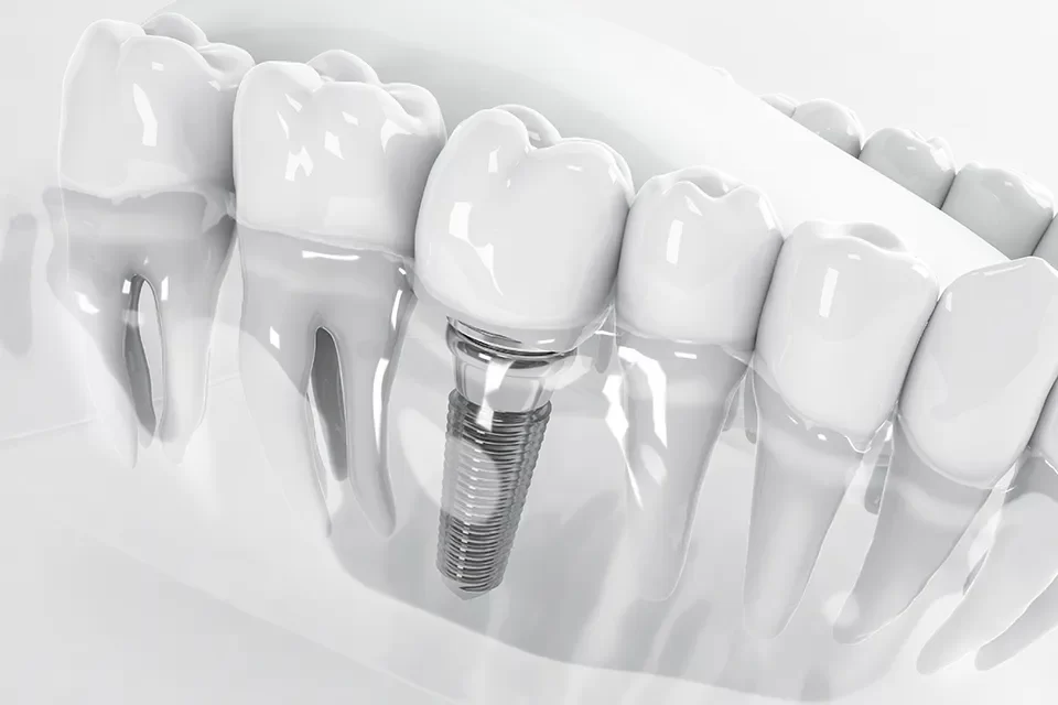 Dental Implant Cost