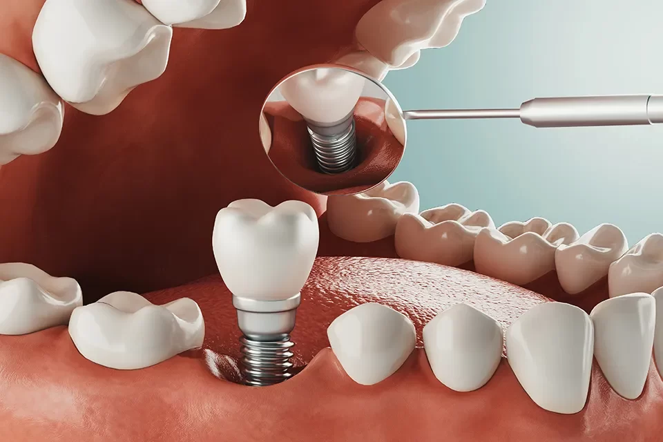 Dental Implants in Richmond Hill