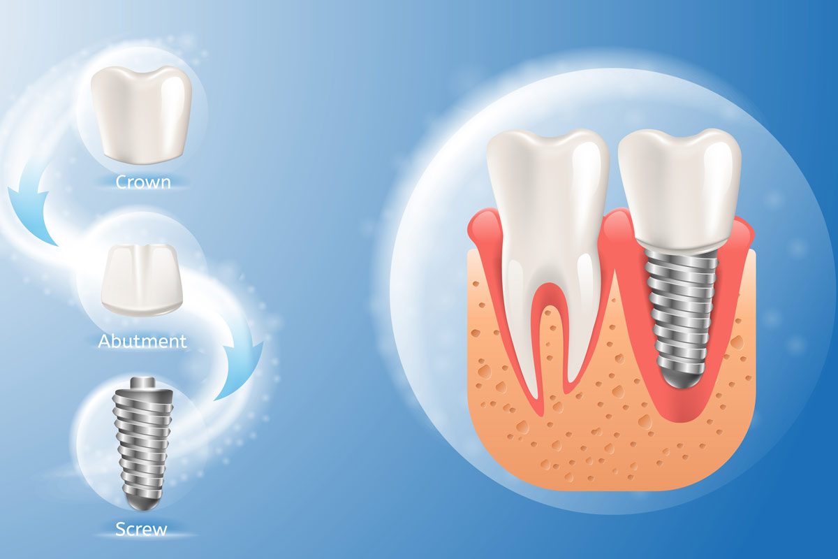 Best Dental Implants in Richmond Hill, Toronto
