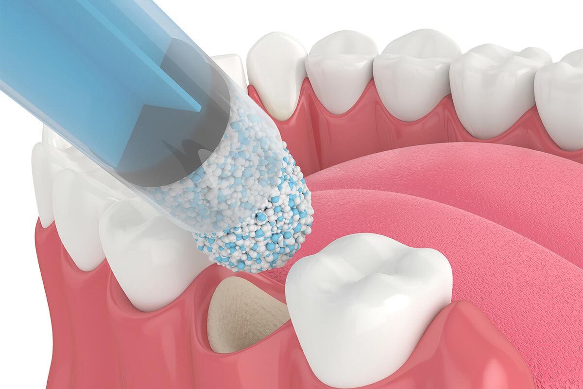 Bone Grafting Treating Bone Loss with Bone Grafting